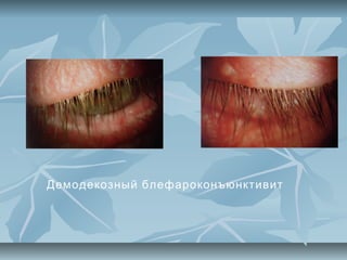 Демодекозный блефароконъюнктивит
 