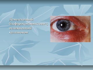 Демодекозный
блефароконъюнктивит,
осложненный
халазионом
 