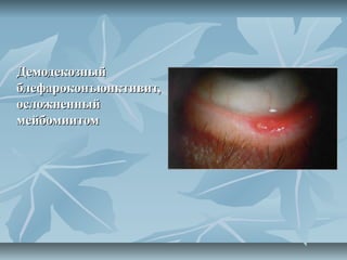 Демодекозный
блефароконъюнктивит,
осложненный
мейбомиитом
 