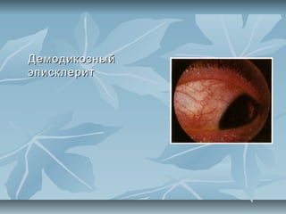 Демодикозный
эписклерит




       .
 