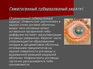 Гематогенный туберкулезный кератит

Ограниченный туберкулезный
кератит. Инфильтрат расположен в
задних слоях роговой оболочки,
вокруг него роговица может
оставаться прозрачной либо
диффузно мутнеет; васкуляризация
роговицы умеренная. Кератит часто
сопровождается образованием
складок в десцеметовой оболочке,
отложением преципитатов на
задней поверхности роговицы и
выраженной реакцией радужной
оболочки. Инфильтраты роговицы
частично рассасываются либо
изъязвляются.
 