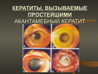 КЕРАТИТЫ, ВЫЗЫВАЕМЫЕ
     ПРОСТЕЙШИМИ
 АКАНТАМЕБНЫЙ КЕРАТИТ
 