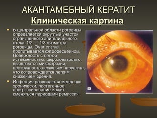 АКАНТАМЕБНЫЙ КЕРАТИТ
         Клиническая картина
   В центральной области роговицы
    определяется округлый участок
    ограниченного эпителиального
    отека, 1/2 — 1/3 диаметра
    роговицы. Очаг слегка
    пропитывается флюoресцеином.
    Поверхность с легкой
    истыканностью, шероховатостью,
    выявляются микроэрозии,
    прозрачность несколько нарушена,
    что сопровождается легким
    снижением зрения.
   Инфекция развивается медленно,
    хронически, постепенное
    прогрессирование может
    сменяться периодами ремиссии.
 