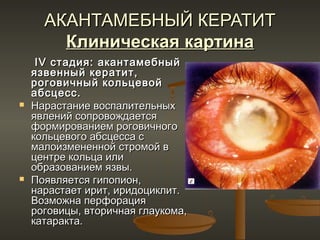 АКАНТАМЕБНЫЙ КЕРАТИТ
        Клиническая картина
     IV стадия: акантамебный
    язвенный кератит,
    роговичный кольцевой
    абсцесс.
   Нарастание воспалительных
    явлений сопровождается
    формированием роговичного
    кольцевого абсцесса с
    малоизмененной стромой в
    центре кольца или
    образованием язвы.
   Появляется гипопион,
    нарастает ирит, иридоциклит.
    Возможна перфорация
    роговицы, вторичная глаукома,
    катаракта.
 