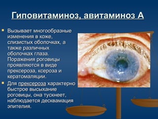 Гиповитаминоз, авитаминоз А
   Вызывает многообразные
    изменения в коже,
    слизистых оболочках, а
    также различных
    оболочках глаза.
    Поражения роговицы
    проявляются в виде
    прексероза, ксероза и
    кератомаляции.
   Для прексероза характерно
    быстрое высыхание
    роговицы, она тускнеет,
    наблюдается десквамация
    эпителия.
 