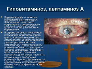 Гиповитаминоз, авитаминоз А
   Кератомаляция — тяжелое
    проявление авитаминоза А.
    Заболевание чаще всего
    встречается у детей грудного
    возраста, реже у взрослых и
    беременных.
   В строме роговицы появляется
    помутнение желтовато-серого
    цвета, эпителий над ним легко
    отслаивается. Инфильтрированные
    участки роговичной ткани
    отторгаются. Чувствительность
    роговицы обычно отсутствует, и
    процесс ее распада происходит
    безболезненно. В течение
    нескольких дней может наступить
    разрушение и прободение
    роговицы. Процесс заканчивается
    образованием стафиломатозного
    бельма или атрофией глазного
    яблока.
 