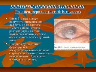 КЕРАТИТЫ НЕЯСНОЙ ЭТИОЛОГИИ
      Розацеа-кератит (keratitis rosacea)
   Через 3-4 нед. может
    наступить эпителизация
    дефекта, но не надолго.
    Вместе с новой атакой
    розовых угрей на лице
    появляется новый узелок с
    образованием более глубокой
    язвы.
   В период рубцевания
    формируется
    васкуляризированное бельмо
    с ярко-белыми известковыми
    включениями. Поражение
    часто двустороннее.
 