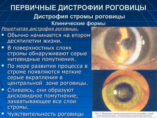 ПЕРВИЧНЫЕ ДИСТРОФИИ РОГОВИЦЫ
            Дистрофия стромы роговицы
                   Клинические формы
Решетчатая дистрофия роговицы.
   Обычно начинается на втором
    десятилетии жизни.
   В поверхностных слоях
    стромы обнаруживают серые
    нитевидные помутнения.
   По мере развития процесса в
    строме появляются мелкие
    серые вкрапления в
    центральной зоне роговицы.
   Сливаясь, они образуют
    дисковидное помутнение,
    захватывающее все слои
    стромы.
   Чувствительность роговицы
 