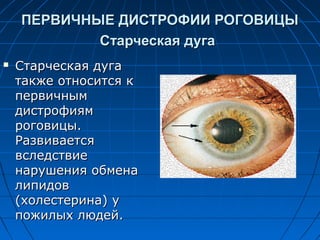 ПЕРВИЧНЫЕ ДИСТРОФИИ РОГОВИЦЫ
            Старческая дуга
   Старческая дуга
    также относится к
    первичным
    дистрофиям
    роговицы.
    Развивается
    вследствие
    нарушения обмена
    липидов
    (холестерина) у
    пожилых людей.
 