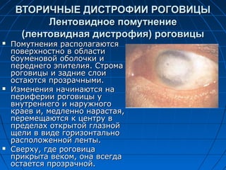 ВТОРИЧНЫЕ ДИСТРОФИИ РОГОВИЦЫ
           Лентовидное помутнение
      (лентовидная дистрофия) роговицы
   Помутнения располагаются
    поверхностно в области
    боуменовой оболочки и
    переднего эпителия. Строма
    роговицы и задние слои
    остаются прозрачными.
   Изменения начинаются на
    периферии роговицы у
    внутреннего и наружного
    краев и, медленно нарастая,
    перемещаются к центру в
    пределах открытой глазной
    щели в виде горизонтально
    расположенной ленты.
   Сверху, где роговица
    прикрыта веком, она всегда
    остается прозрачной.
 