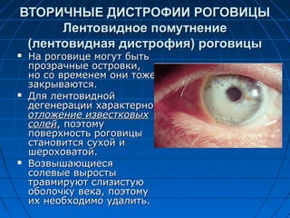 ВТОРИЧНЫЕ ДИСТРОФИИ РОГОВИЦЫ
      Лентовидное помутнение
 (лентовидная дистрофия) роговицы
   На роговице могут быть
    прозрачные островки,
    но со временем они тоже
    закрываются.
   Для лентовидной
    дегенерации характерно
    отложение известковых
    солей, поэтому
    поверхность роговицы
    становится сухой и
    шероховатой.
   Возвышающиеся
    солевые выросты
    травмируют слизистую
    оболочку века, поэтому
    их необходимо удалить.
 