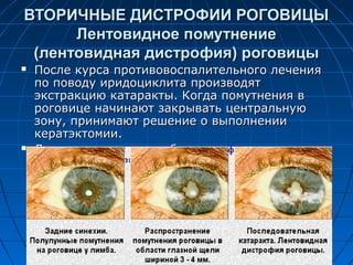 ВТОРИЧНЫЕ ДИСТРОФИИ РОГОВИЦЫ
      Лентовидное помутнение
 (лентовидная дистрофия) роговицы
   После курса противовоспалительного лечения
    по поводу иридоциклита производят
    экстракцию катаракты. Когда помутнения в
    роговице начинают закрывать центральную
    зону, принимают решение о выполнении
    кератэктомии.
   Лечение основного заболевания проводит
    терапевт.
 