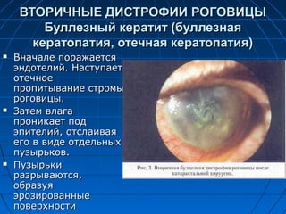 ВТОРИЧНЫЕ ДИСТРОФИИ РОГОВИЦЫ
         Буллезный кератит (буллезная
       кератопатия, отечная кератопатия)
   Вначале поражается
    эндотелий. Наступает
    отечное
    пропитывание стромы
    роговицы.
   Затем влага
    проникает под
    эпителий, отслаивая
    его в виде отдельных
    пузырьков.
   Пузырьки
    разрываются,
    образуя
    эрозированные
    поверхности
 