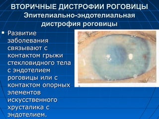 ВТОРИЧНЫЕ ДИСТРОФИИ РОГОВИЦЫ
       Эпителиально-эндотелиальная
           дистрофия роговицы
   Развитие
    заболевания
    связывают с
    контактом грыжи
    стекловидного тела
    с эндотелием
    роговицы или с
    контактом опорных
    элементов
    искусственного
    хрусталика с
    эндотелием.
 