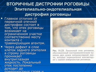 ВТОРИЧНЫЕ ДИСТРОФИИ РОГОВИЦЫ
        Эпителиально-эндотелиальная
            дистрофия роговицы
   Главное отличие от
    первичной отечной
    дистрофии состоит в
    том, что отек роговицы
    возникает на
    ограниченном участке
    соответственно месту
    контакта с
    травмирующим агентом.
   Через дефект в слое
    клеток заднего эпителия
    в строму роговицы
    проникает
    внутриглазная
    жидкость. Локальный
    отек постепенно
    доходит до
 