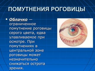 ПОМУТНЕНИЯ РОГОВИЦЫ
   Облачко —
    ограниченное
    помутнение роговицы
    серого цвета, едва
    улавливаемое при
    осмотре. При
    помутнениях в
    центральной зоне
    роговицы может
    незначительно
    снижаться острота
    зрения.
 