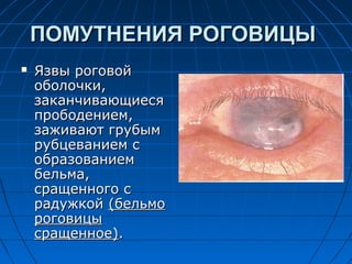 ПОМУТНЕНИЯ РОГОВИЦЫ
   Язвы роговой
    оболочки,
    заканчивающиеся
    прободением,
    заживают грубым
    рубцеванием с
    образованием
    бельма,
    сращенного с
    радужкой (бельмо
    роговицы
    сращенное).
 