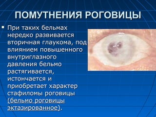 ПОМУТНЕНИЯ РОГОВИЦЫ
   При таких бельмах
    нередко развивается
    вторичная глаукома, под
    влиянием повышенного
    внутриглазного
    давления бельмо
    растягивается,
    истончается и
    приобретает характер
    стафиломы роговицы
    (бельмо роговицы
    эктазированное).
 