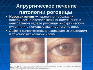 Хирургическое лечение
        патологии роговицы
   Кератэктомия — удаление небольших
    поверхностно расположенных помутнений в
    центральном отделе роговицы хирургическим
    путем или с помощью эксимерного лазера.
   Дефект самостоятельно закрывается эпителием
    в течение нескольких часов.
 