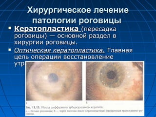 Хирургическое лечение
        патологии роговицы
   Кератопластика (пересадка
    роговицы) — основной раздел в
    хирургии роговицы.
   Оптическая кератопластика. Главная
    цель операции восстановление
    утраченного зрения.
 