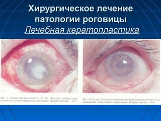 Хирургическое лечение
  патологии роговицы
Лечебная кератопластика
 