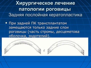 Хирургическое лечение
        патологии роговицы
    Задняя послойная кератопластика
   При задней ПК трансплантатом
    замещаются только задние слои
    роговицы (часть стромы, десцеметова
    оболочка, эндотелий).
 