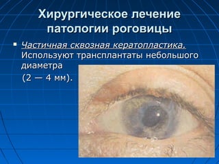 Хирургическое лечение
        патологии роговицы
   Частичная сквозная кератопластика.
    Используют трансплантаты небольшого
    диаметра
    (2 — 4 мм).
 