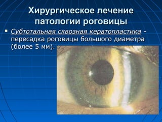 Хирургическое лечение
         патологии роговицы
   Субтотальная сквозная кератопластика -
    пересадка роговицы большого диаметра
    (более 5 мм).
 