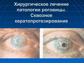 Хирургическое лечение
 патологии роговицы.
      Сквозное
кератопротезирование
 