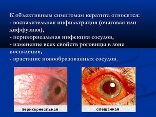 К объективным симптомам кератита относятся:
- воспалительная инфильтрация (очаговая или
диффузная),
- перикорнеальная инфекция сосудов,
- изменение всех свойств роговицы в зоне
воспаления,
- врастание новообразованных сосудов.
 