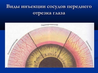 Виды инъекции сосудов переднего
         отрезка глаза
 