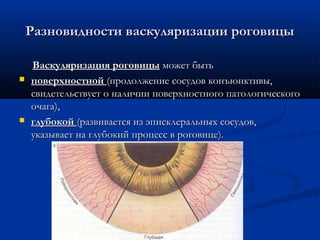 Разновидности васкуляризации роговицы

    Васкуляризация роговицы может быть
   поверхностной (продолжение сосудов конъюнктивы,
    свидетельствует о наличии поверхностного патологического
    очага),
   глубокой (развивается из эписклеральных сосудов,
    указывает на глубокий процесс в роговице).
 