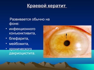 Краевой кератит

    Развивается обычно на
    фоне:
•   инфекционного
    конъюнктивита,
•   блефарита,
•   мейбомита,
•   хронического
    дакриоцистита.
 