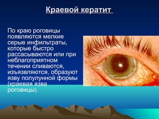 Краевой кератит

По краю роговицы
появляются мелкие
серые инфильтраты,
которые быстро
рассасываются или при
неблагоприятном
течении сливаются,
изъязвляются, образуют
язву полулунной формы
(краевая язва
роговицы).
 