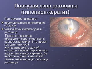 Ползучая язва роговицы
        (гипопион-кератит)
При осмотре выявляют:
перикорнеальную инъекцию
сосудов,
желтоватый инфильтрат в
роговице.
 После его распада
образуется язва, склонная к
распространению. В то время
как один его край
эпителизируется, другой
остается инфильтрированным,
подрытым в виде кармана. За
несколько дней язва может
занять значительную площадь
роговицы.
 