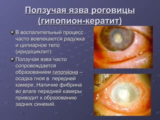 Ползучая язва роговицы
     (гипопион-кератит)
В воспалительный процесс
часто вовлекаются радужка
и цилиарное тело
(иридоциклит).
Ползучая язва часто
сопровождается
образованием гипопиона –
осадка гноя в передней
камере. Наличие фибрина
во влаге передней камеры
приводит к образованию
задних синехий.
 