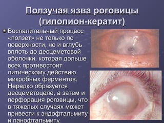 Ползучая язва роговицы
       (гипопион-кератит)
Воспалительный процесс
«ползет» не только по
поверхности, но и вглубь
вплоть до десцеметовой
оболочки, которая дольше
всех противостоит
литическому действию
микробных ферментов.
Нередко образуется
десцеметоцеле, а затем и
перфорация роговицы, что
в тяжелых случаях может
привести к эндофтальмиту
и панофтальмиту.
 