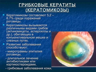 ГРИБКОВЫЕ КЕРАТИТЫ
              (КЕРАТОМИКОЗЫ)
    Кератомикозы составляют 5,2 –
     6,7% среди поражений
     роговицы.
    Кератомикозы вызываются
     различными видами грибов
     (актиномицеты, аспергиллы и
     др.), обитающих в
     конъюнктивальном мешке и
     слезных путях.
    Развитию заболевания
     способствуют:
    - микротравмы эпителия
     роговицы,
    - длительное лечение
     антибиотиками или
     кортикостероидами,
    - грибковые заболевания кожи.
 