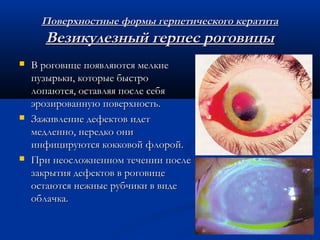 Поверхностные формы герпетического кератита
      Везикулезный герпес роговицы
   В роговице появляются мелкие
    пузырьки, которые быстро
    лопаются, оставляя после себя
    эрозированную поверхность.
   Заживление дефектов идет
    медленно, нередко они
    инфицируются кокковой флорой.
   При неосложненном течении после
    закрытия дефектов в роговице
    остаются нежные рубчики в виде
    облачка.
 