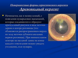 Поверхностные формы герпетического кератита
                Древовидный кератит
   Начинается, как и везикулезный, с
    появления пузырьковых высыпаний,
    которые соединяются и образуют
    причудливый рисунок в виде веточек
    дерева в центре роговицы (что
    объясняется распространением вируса
    по ходу веточек субэпителиальных
    нервов роговицы). При внимательном
    осмотре на щелевой лампе на конце
    каждого ответвления можно увидеть
    утолщение, или пузырек.
 
