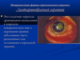 Поверхностные формы герпетического кератита
            Ландкартообразный кератит
   Это следствие перехода
    древовидного воспаления
    в широкую
    поверхностную язву с
    неровными краями;
    заболевание часто
    расценивают как
    осложнение стероидной
    терапии.
 