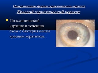 Поверхностные формы герпетического кератита
       Краевой герпетический кератит
   По клинической
    картине и течению
    схож с бактериальным
    краевым кератитом.
 