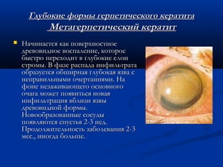Глубокие формы герпетического кератита
            Метагерпетический кератит
   Начинается как поверхностное
    древовидное воспаление, которое
    быстро переходит в глубокие слои
    стромы. В фазе распада инфильтрата
    образуется обширная глубокая язва с
    неправильными очертаниями. На
    фоне незаживающего основного
    очага может появиться новая
    инфильтрация вблизи язвы
    древовидной формы.
    Новообразованные сосуды
    появляются спустья 2-3 нед.
    Продолжительность заболевания 2-3
    мес., иногда больше.
 