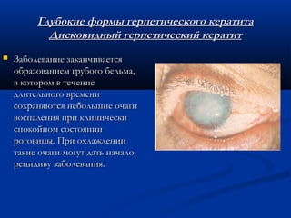 Глубокие формы герпетического кератита
           Дисковидный герпетический кератит
   Заболевание заканчивается
    образованием грубого бельма,
    в котором в течение
    длительного времени
    сохраняются небольшие очаги
    воспаления при клинически
    спокойном состоянии
    роговицы. При охлаждении
    такие очаги могут дать начало
    рецидиву заболевания.
 