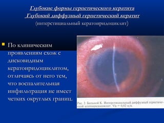 Глубокие формы герпетического кератита
          Глубокий диффузный герпетический кератит
             (интерстициальный кератоиридоциклит)


   По клиническим
    проявлениям схож с
    дисковидным
    кератоиридоциклитом,
    отличаясь от него тем,
    что воспалительная
    инфильтрация не имеет
    четких округлых границ.
 