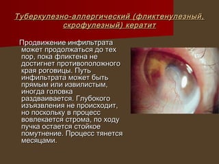 Туберкулезно-аллергический (фликтенулезный,
           скрофулезный) кератит

 Продвижение инфильтрата
 может продолжаться до тех
 пор, пока фликтена не
 достигнет противоположного
 края роговицы. Путь
 инфильтрата может быть
 прямым или извилистым,
 иногда головка
 раздваивается. Глубокого
 изъязвления не происходит,
 но поскольку в процесс
 вовлекается строма, по ходу
 пучка остается стойкое
 помутнение. Процесс тянется
 месяцами.
 