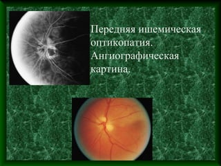 Передняя ишемическая
оптикопатия.
Ангиографическая
картина.
 