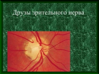 Друзы зрительного нерва.
 