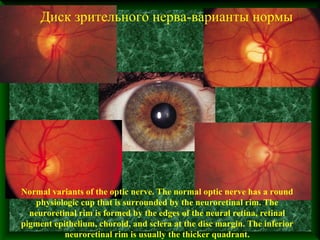 Диск зрительного нерва-варианты нормы




Normal variants of the optic nerve. The normal optic nerve has a round
   physiologic cup that is surrounded by the neuroretinal rim. The
  neuroretinal rim is formed by the edges of the neural retina, retinal
pigment epithelium, choroid, and sclera at the disc margin. The inferior
           neuroretinal rim is usually the thicker quadrant.
 