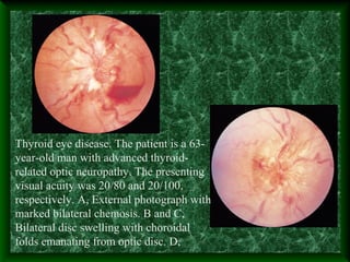 Thyroid eye disease. The patient is a 63-
year-old man with advanced thyroid-
related optic neuropathy. The presenting
visual acuity was 20/80 and 20/100,
respectively. A, External photograph with
marked bilateral chemosis. B and C,
Bilateral disc swelling with choroidal
folds emanating from optic disc. D,
 